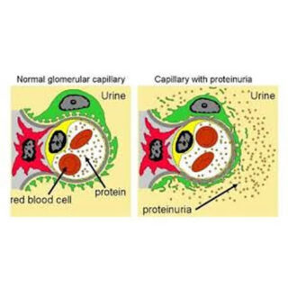 Proteínas en orina